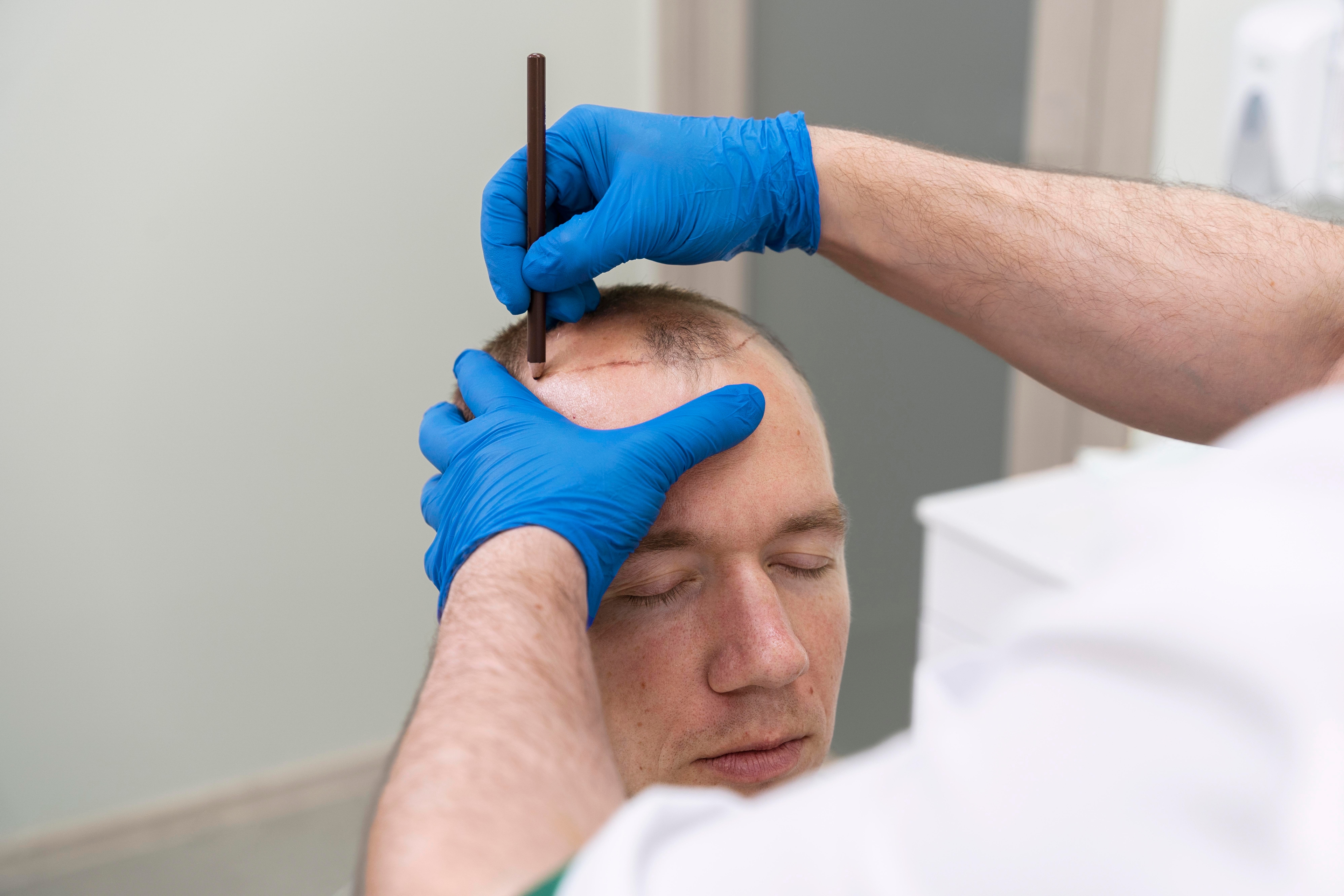 Surgeon measuring recipient area and marking hairline before graft calculation — Firma Clinic Istanbul, Norwood scale planning 2026